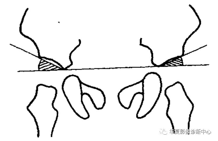 先天性髋关节脱位截骨术全过程,先天性髋关节脱位可以考驾驶证吗