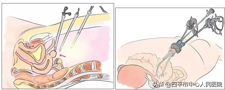 宫腔镜腹腔镜手术一起做多少钱,宫腔镜和腹腔镜手术各需多少钱