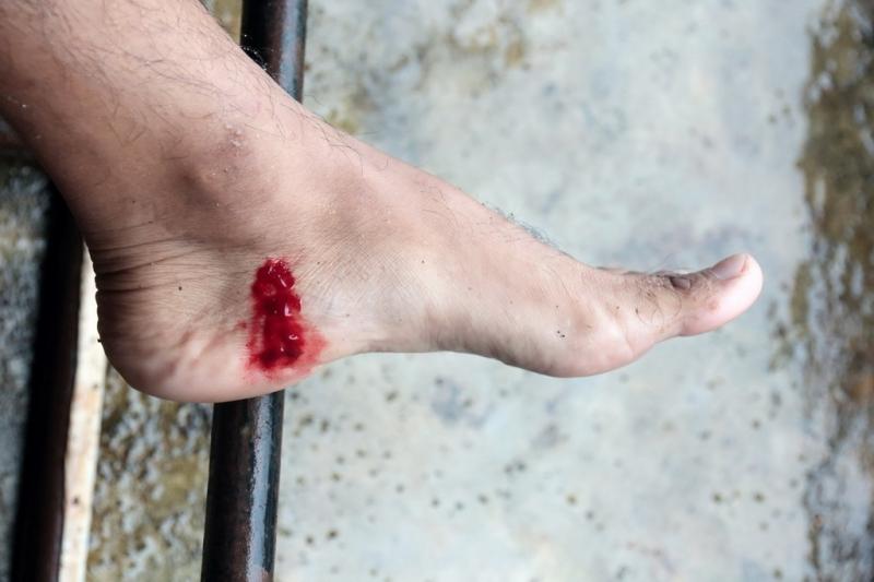 在野外被蚂蟥吸血了怎么办,户外登山如何防蚂蟥