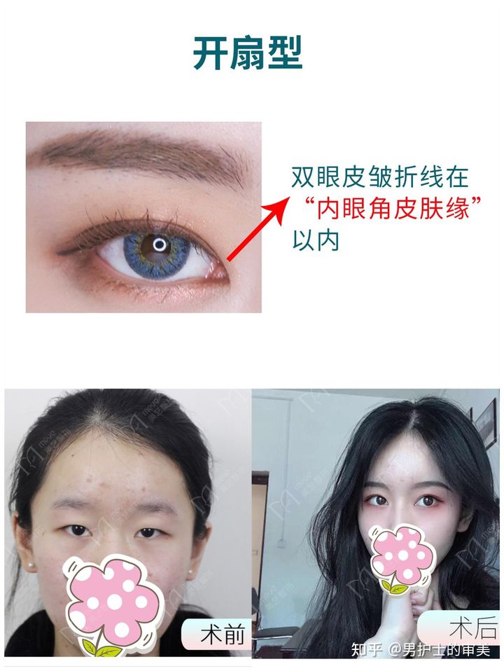 开扇形双眼皮上扬和下垂,做双眼皮后眼尾弧度有个拐弯