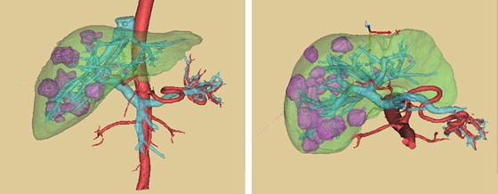 肝脏结节是恶性的吗,肝脏结节恶性的几率大吗