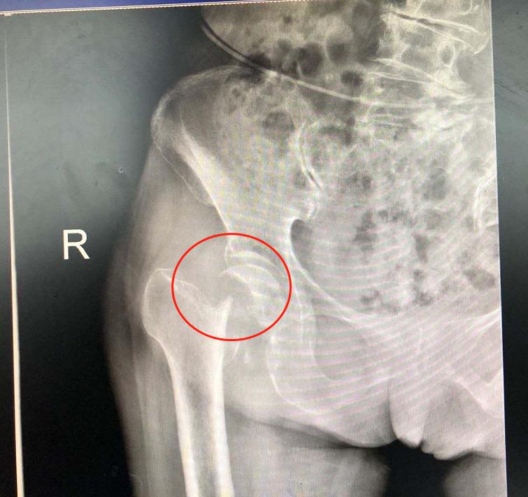 髋关节骨折180天弯曲受限,股骨颈骨折八个月髋关节弯曲受限