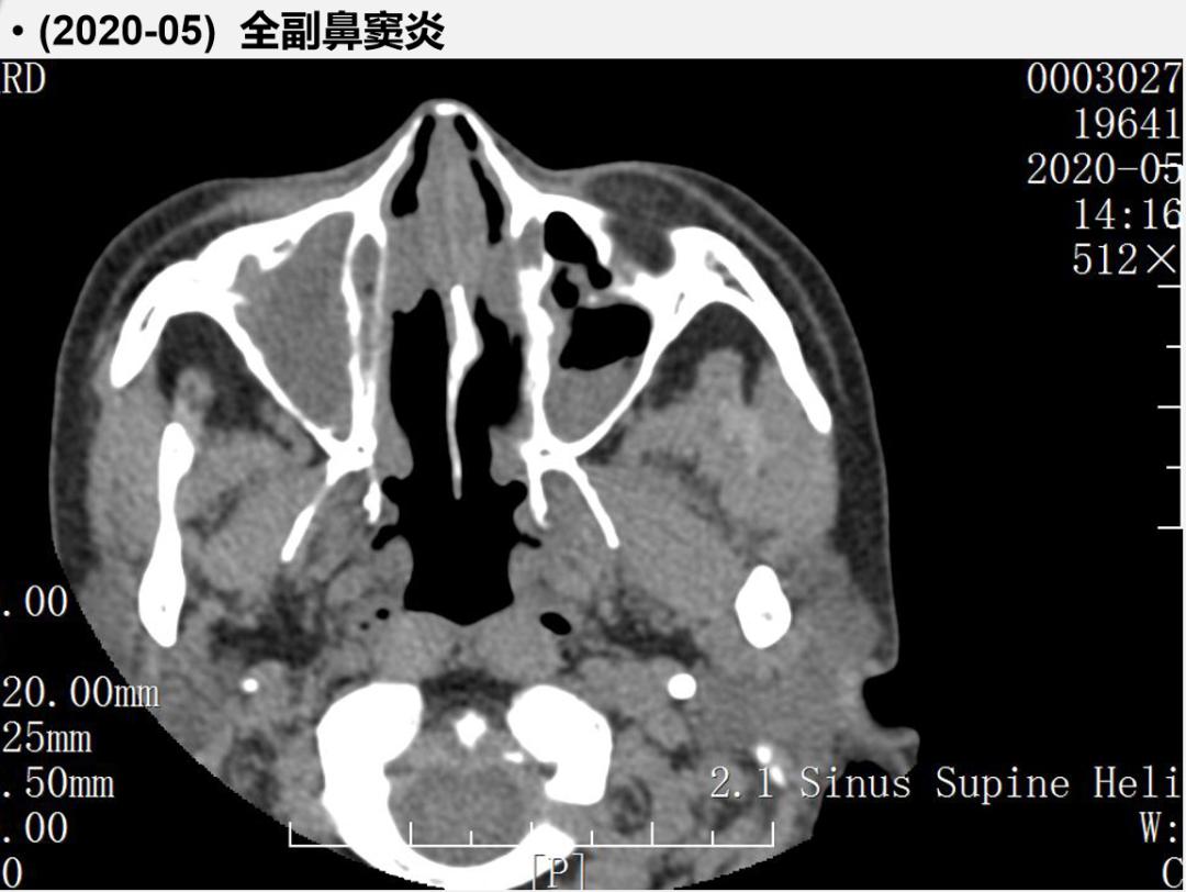 哮喘规范治疗后肺功能依然很差,哮喘治疗半年了还是喘