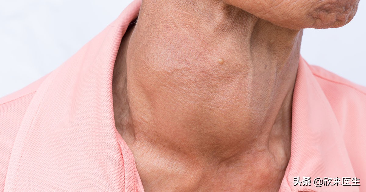 甲状腺功能减退补碘吗,甲状腺功能减退可以吃含碘的盐吗