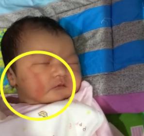 产钳孩子是不是一定有后遗症,产钳夹的印多久可以消失