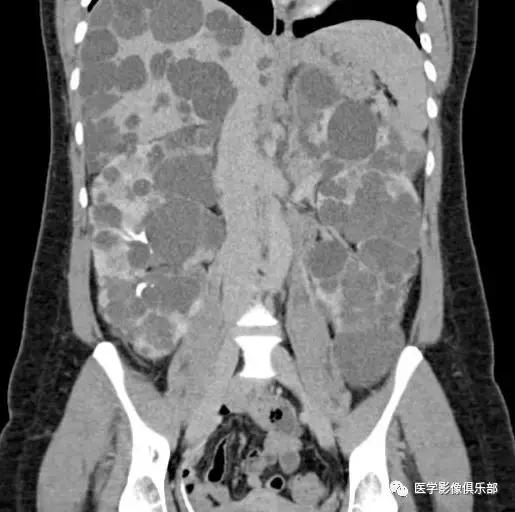 双肾多发小囊肿到底是不是多囊肾,肾多发囊肿与多囊肾的超声鉴别