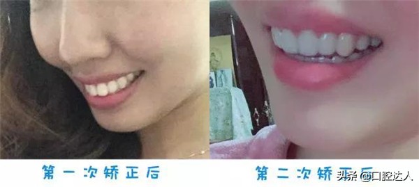 牙齿矫正步骤流程,牙齿矫正怎么操作