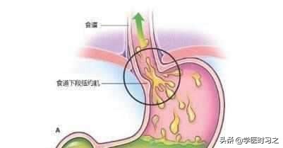 返流性食管炎常用药物治疗