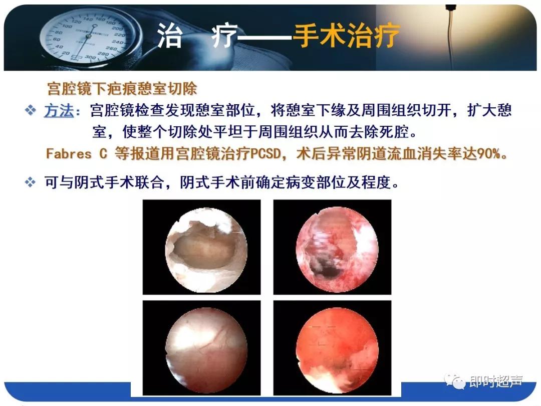 孕妇剖宫产瘢痕憩室,剖宫产瘢痕憩室息肉