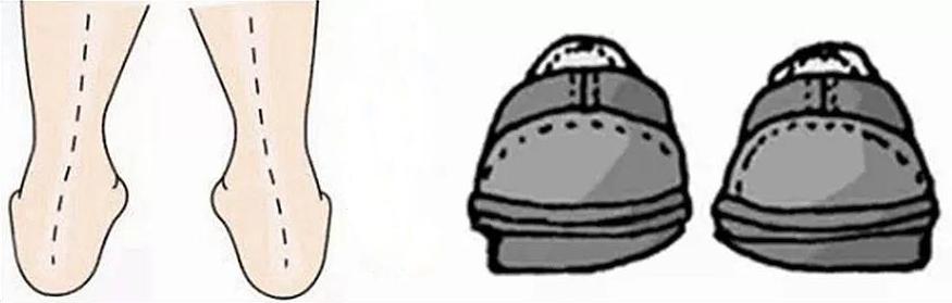 双脚外侧鞋底磨损严重,双脚鞋底磨损程度不同