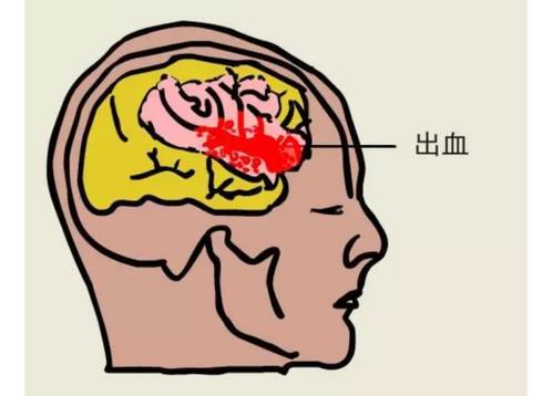 脑中风治疗一般几个疗程,一分钟识别脑卒中正确的做法