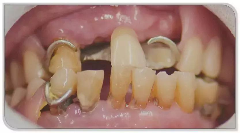 79岁老人看牙经历：不敢拔牙、不想种牙、不戴挂钩牙，怎么修复？