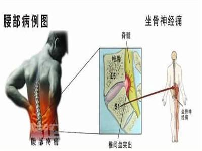 坐骨神经痛腿疼站立行走可以缓解,坐骨神经痛无法行走