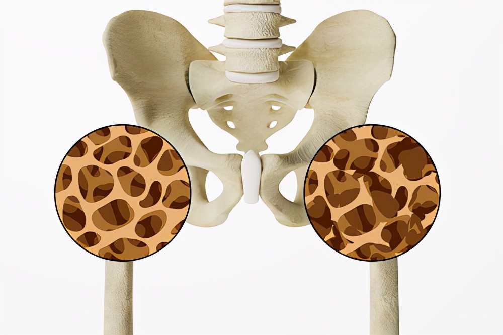 骨质疏松骨被压扁怎样治疗,骨质被破坏有什么办法修复