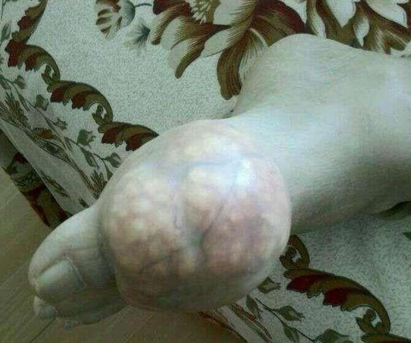 为什么医生不建议痛风石手术,医生为什么不建议痛风石手术