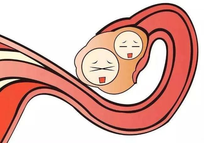 子宫内膜异位症手术费用大概多少,子宫内膜异位症针灸需要几个疗程