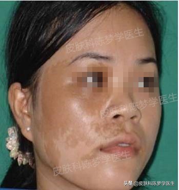 色斑和褐斑,根治面部黑褐斑的方法