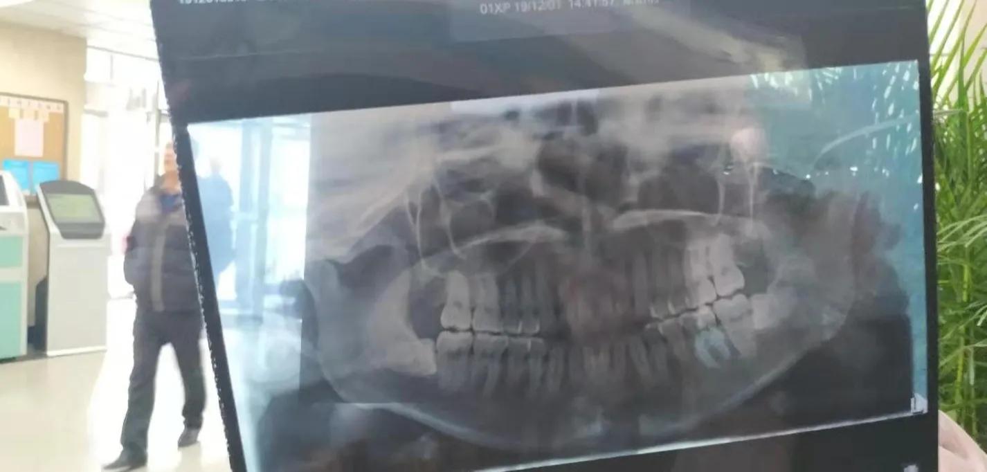 分享一下自己去华西拔智齿的经历,拔智齿经历分享