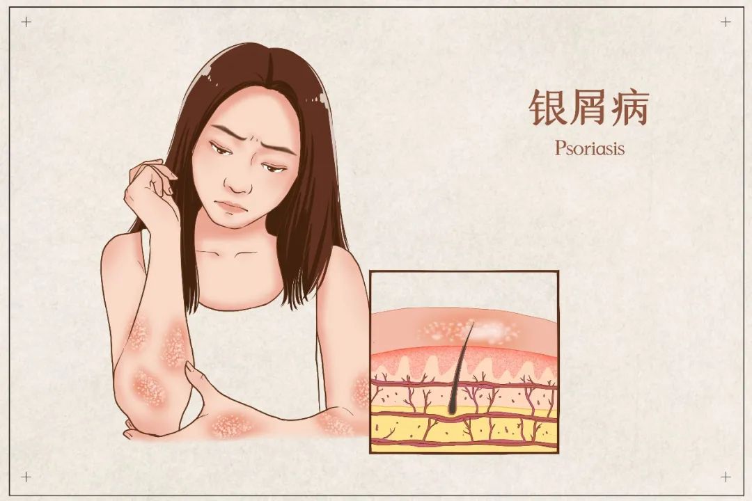 钱看没了，家也散了！都因为这个又掉“鳞”又掉“屑”的病