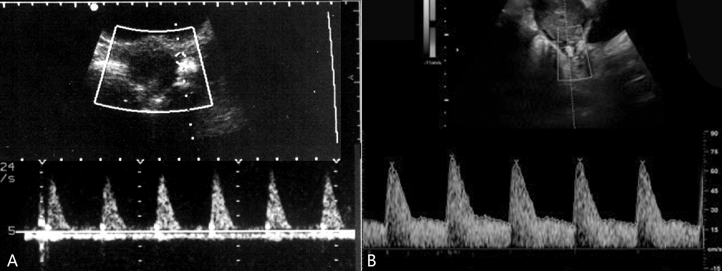 明明白白做超声23-2：妊娠期子宫及卵巢超声多普勒检查