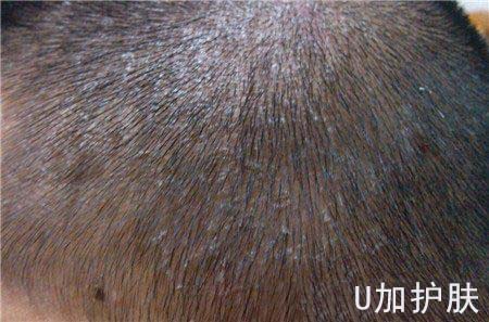 头皮干燥屑多是什么原因,洗头后头皮干燥头皮屑多掉屑很痒