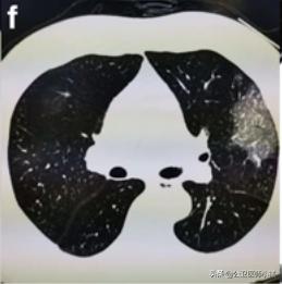 新型冠状病毒肺炎患者的肺,新型冠状病毒患者肺部体征