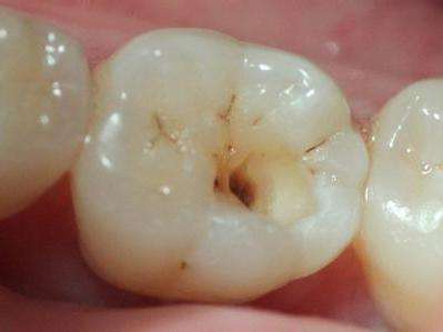 用于牙痛的消炎镇痛药有哪些,止痛药对牙痛有效吗