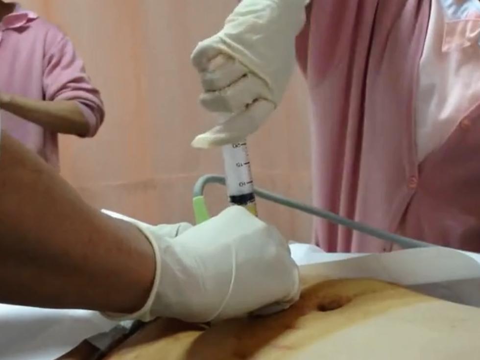 让孕妇妈妈提心吊胆的羊水穿刺,孕妈必须知道的羊水穿刺问题收藏