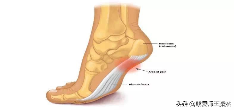 运动后脚底板感觉有一条筋在痛,运动后脚底板无力麻木怎么处理