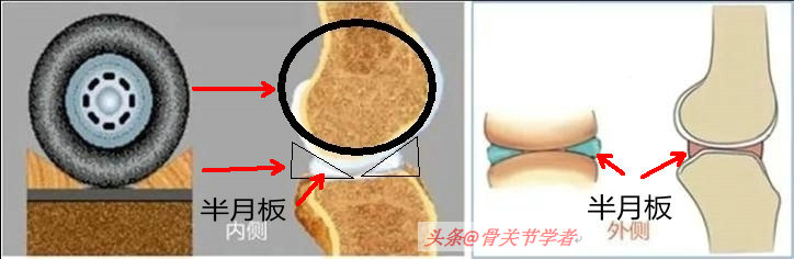 磁共振怎么看半月板损伤程度,磁共振半月板损伤1级是什么