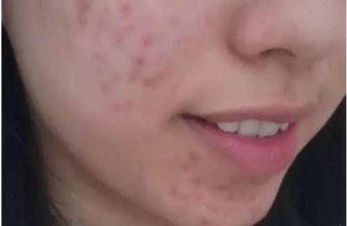 皮肤科脸上长闭口怎么办,皮肤科脸上闭口