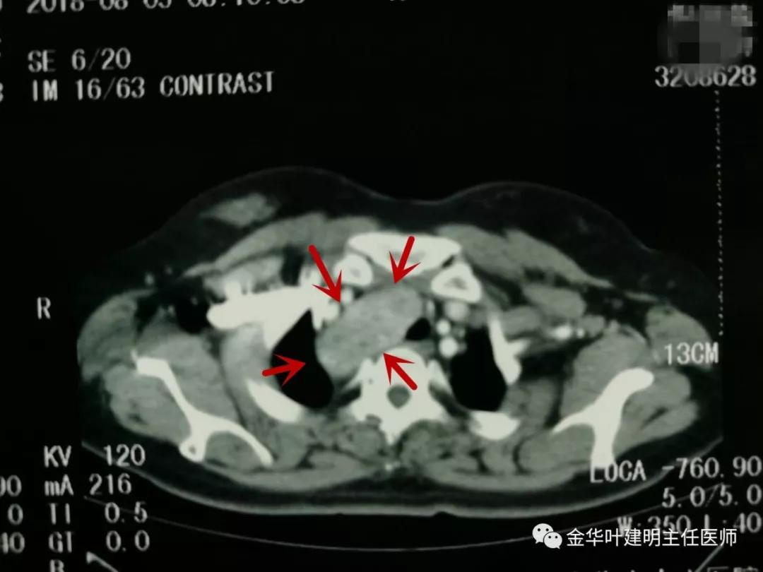 甲状腺肿瘤超大,胸骨后甲状腺肿病情是否很严重