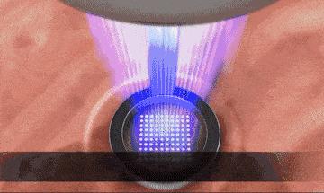 常见的5种激光美容手段，总有一款适合你