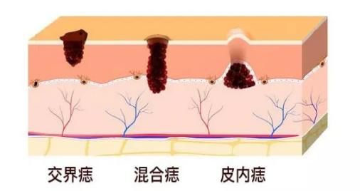 中医点痣最好方法,中医古方中草药点痣