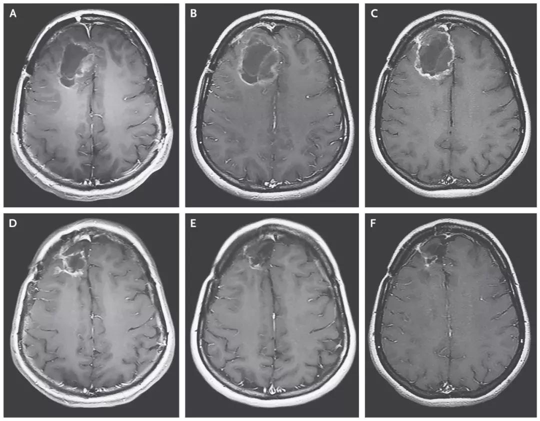 癌症pd1免疫治疗技术,5类癌症病人pdl1免疫治疗效果最好