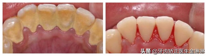 严重牙结石洗牙会疼吗,洗牙只洗牙结石不洗牙齿表面好吗