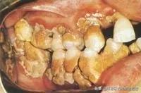 年纪轻轻就有牙周炎,年纪轻轻牙结石严重怎么回事