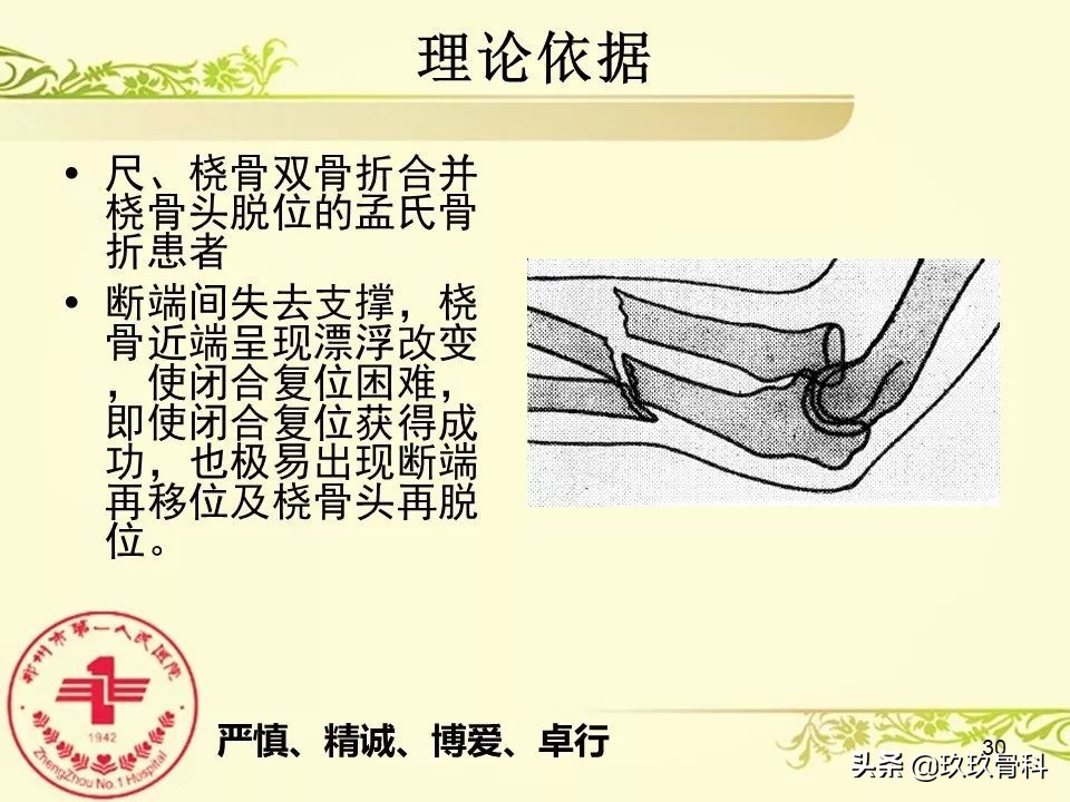 孟氏骨折功能训练多久能恢复正常,孟氏骨折中医能治吗