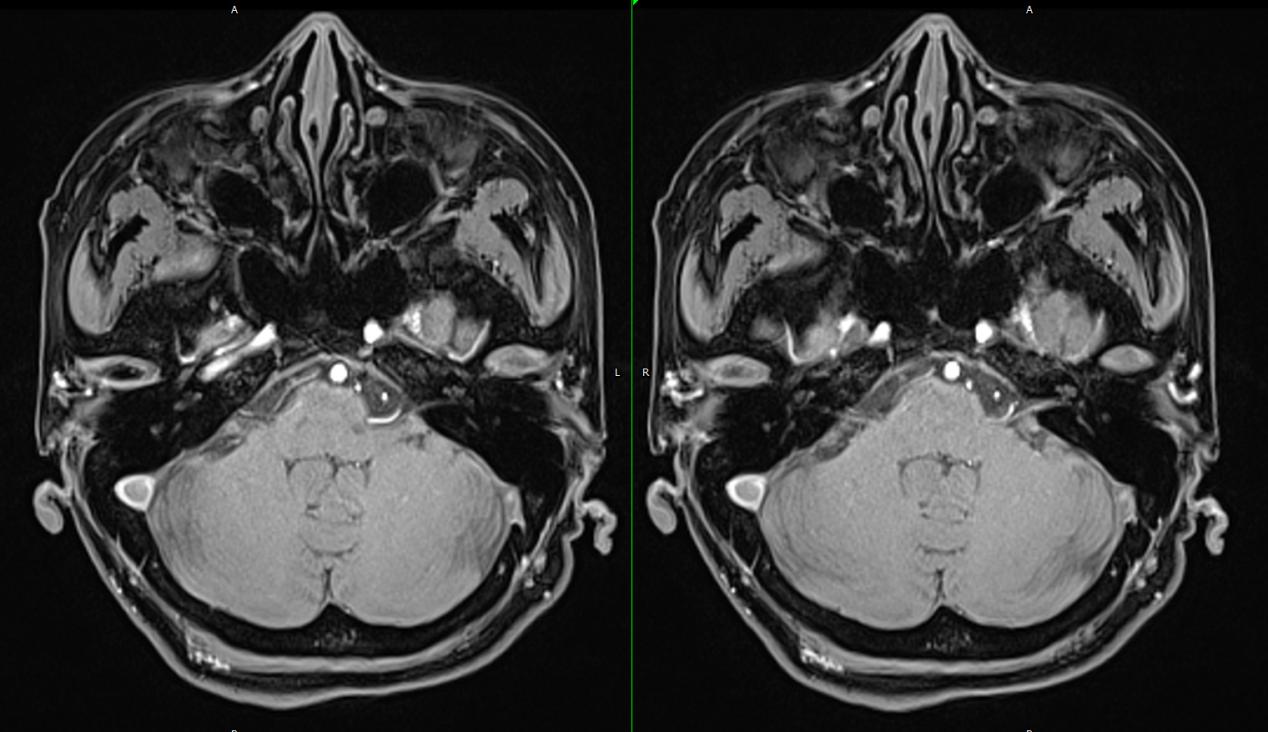 女子多年耳鸣被中医治好,55岁女耳鸣一年多不影响睡眠