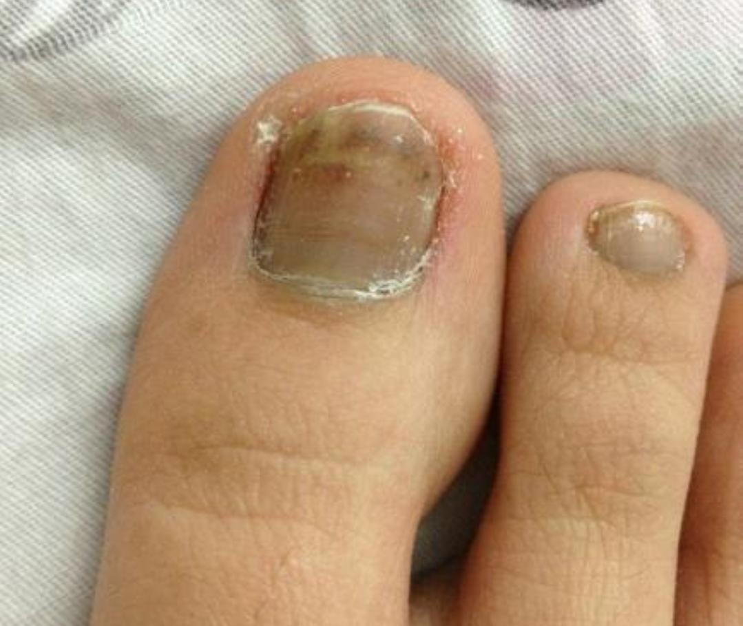 同事有灰指甲怎么预防传染,得了灰指甲怎么预防传染