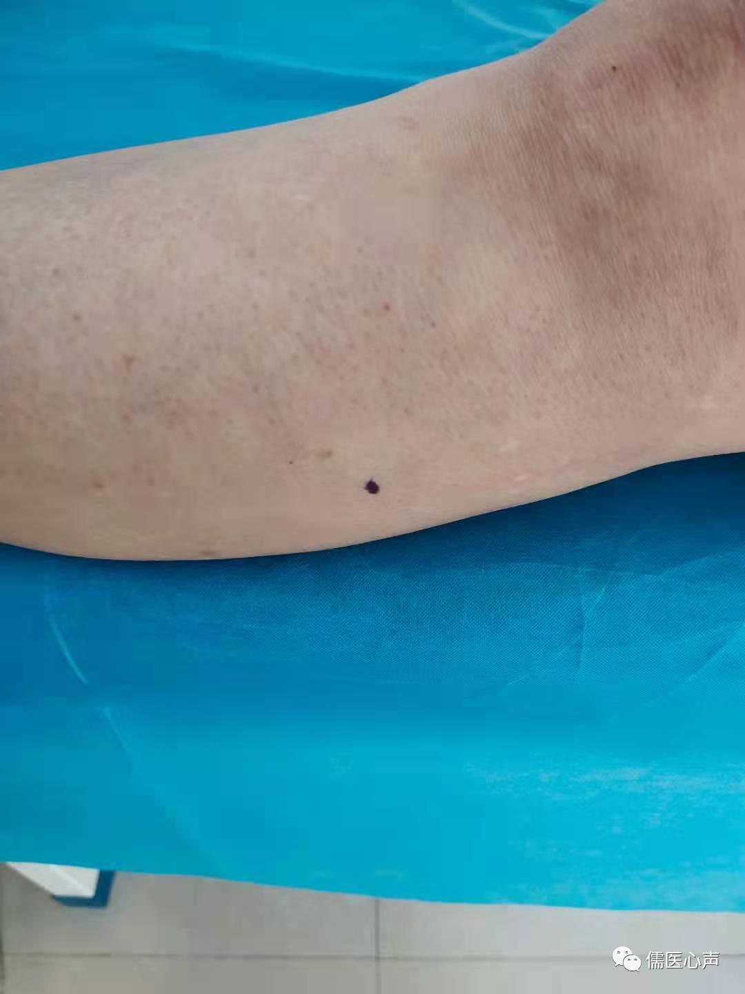 上肢麻痛治疗方法,上肢痛麻怎么回事