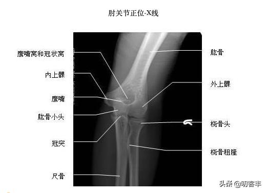 小孩肘关节骨折怎么做康复,儿童肘部骨折怎么办