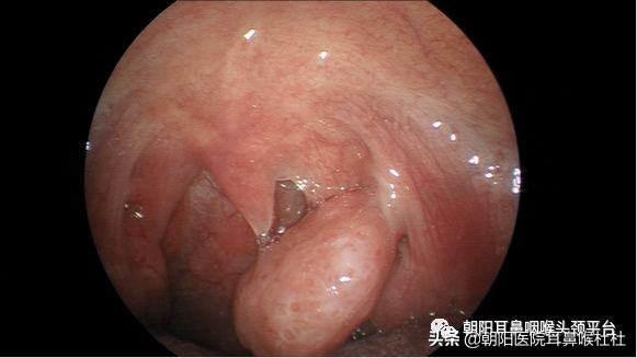 扁桃体腺样体切除后什么时间最痛,扁桃体切除后白膜脱落时更痛了