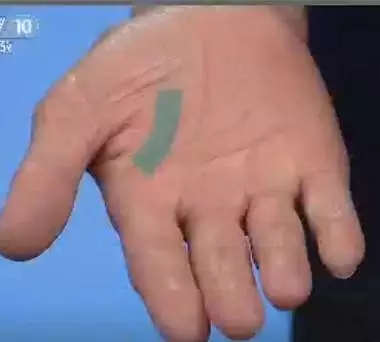 手的健康识别,看手识病疾病自测