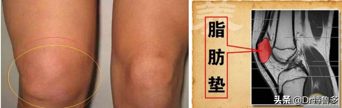 膝盖疼应该知道的几件事,膝眼痛考虑何病