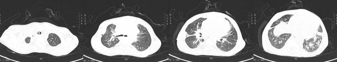 不敢咳嗽如何进行有效排痰,无咳嗽呼吸困难