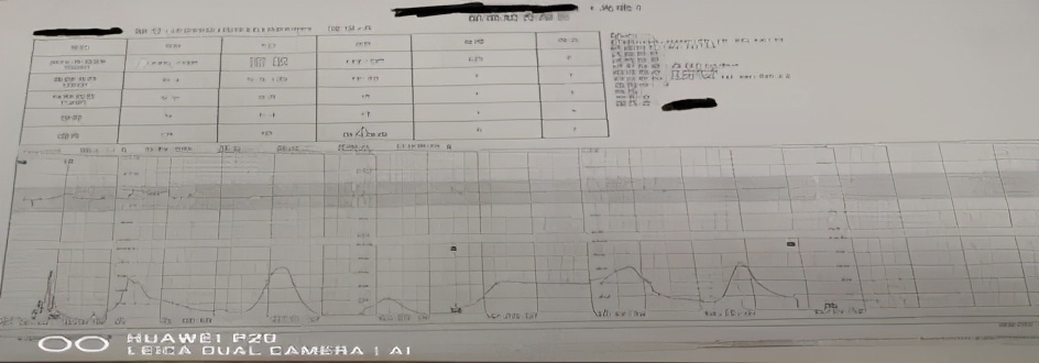 胎儿窘迫案例分析题,胎儿窘迫抢救视频