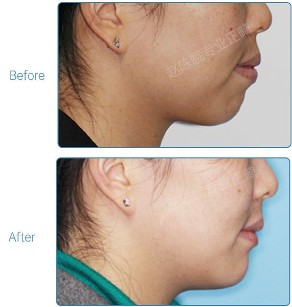 杭州牙齿矫正的全过程,杭州牙齿矫正哪个医生最好