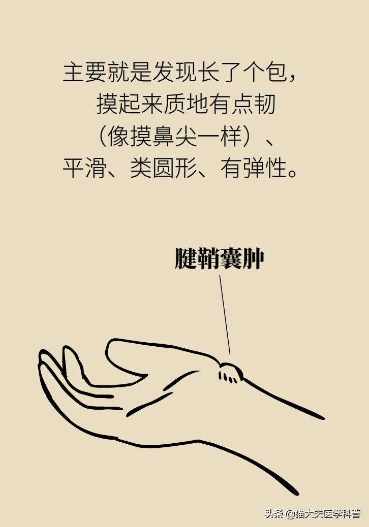 手腕长腱鞘囊肿,手腕上有个凸起的包腱鞘囊肿