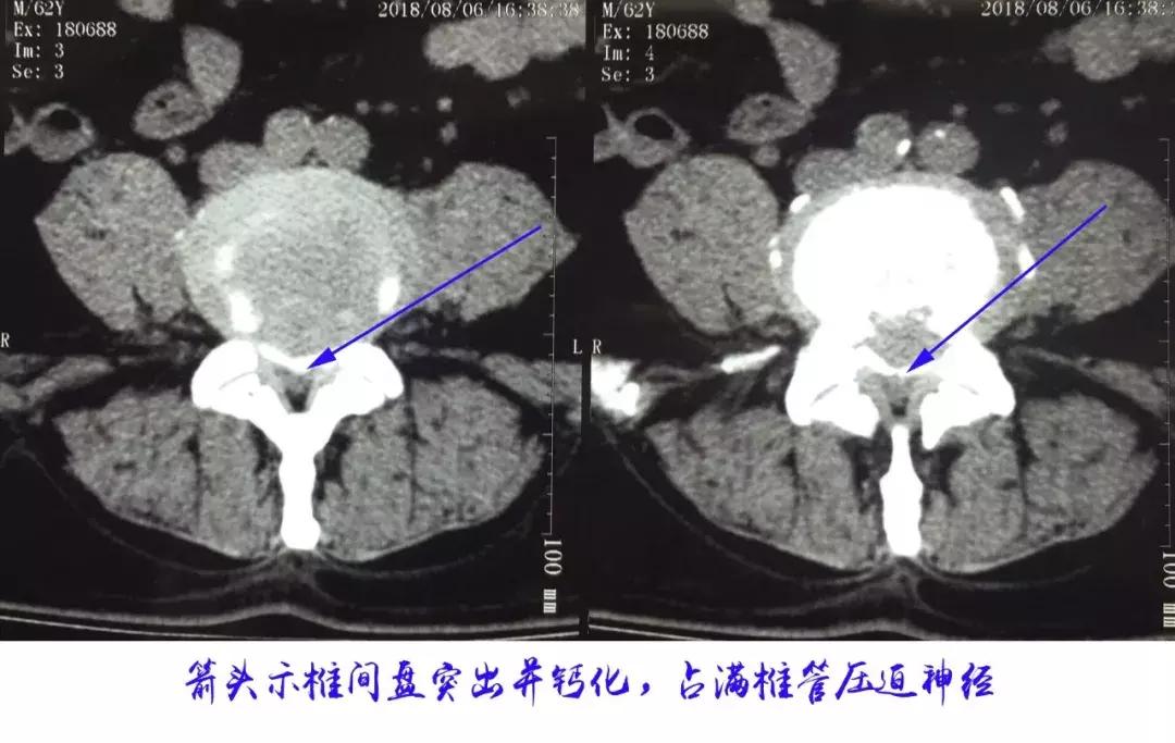 什么人适合微创手术治疗腰突,可视放射性治疗腰突效果怎么样